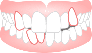 ガタガタした歯並びや八重歯(叢生)