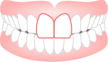 出っ歯(上顎前突)